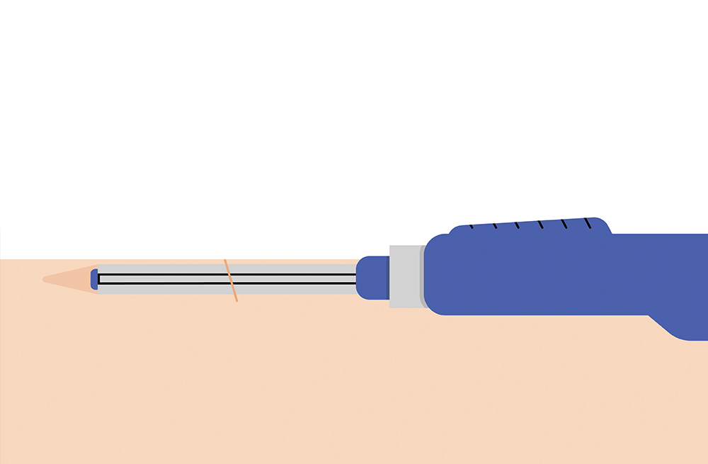 La seconda fase del processo di inserimento del CGM impiantabile del sistema Eversense.